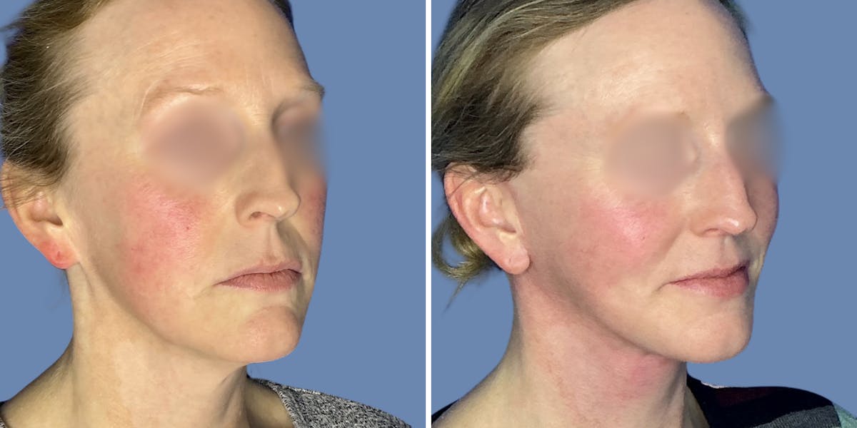 Facelift Before & After Gallery - Patient 197553 - Image 2