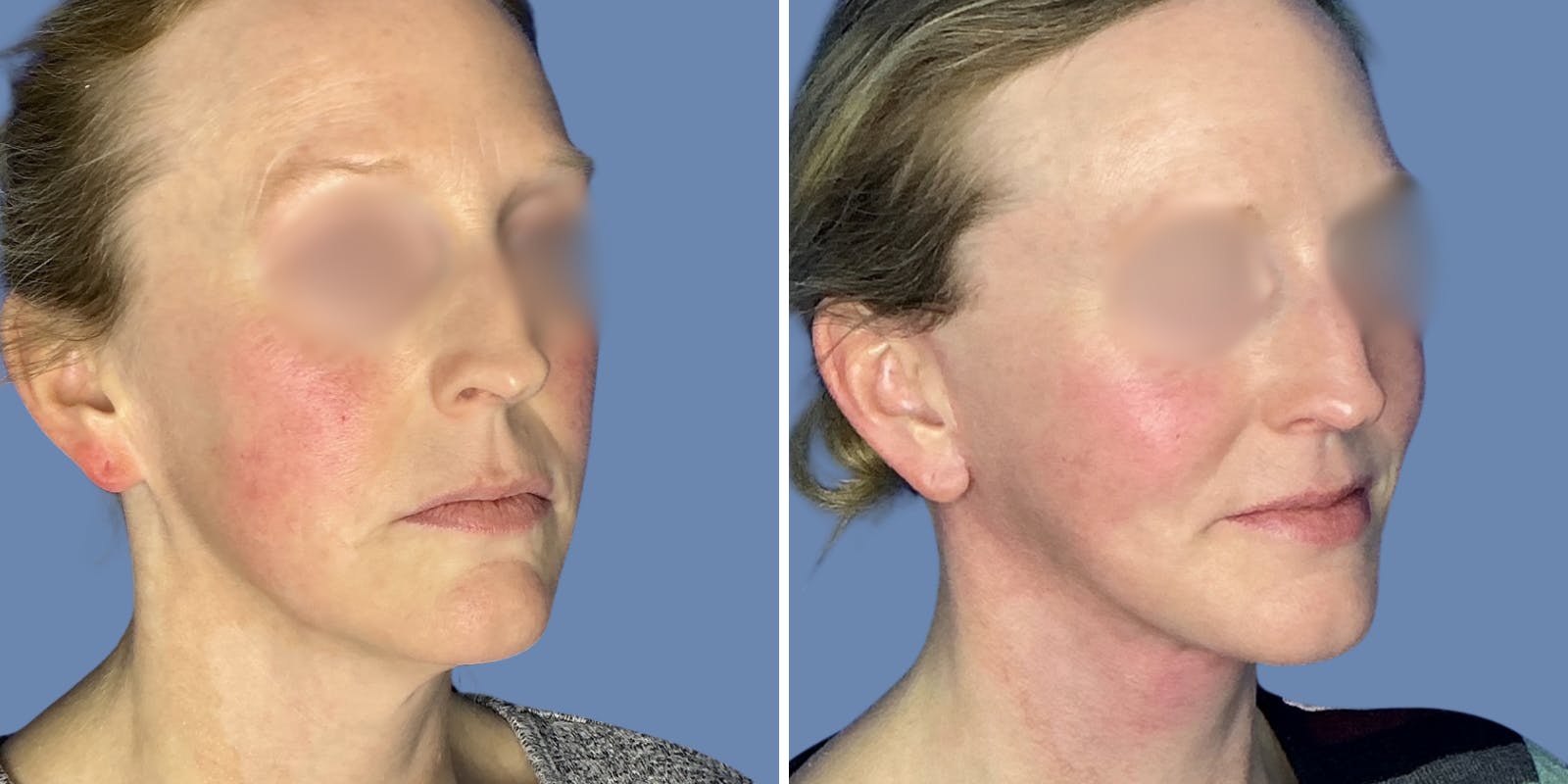 Facelift Before & After Gallery - Patient 197553 - Image 2