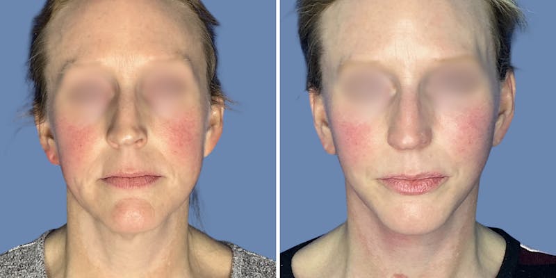 Patient amBMft44R8GpD7OOZKq-bg - Facelift Before & After Photos