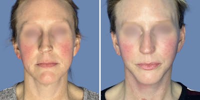 Facelift Before & After Gallery - Patient 197553 - Image 1