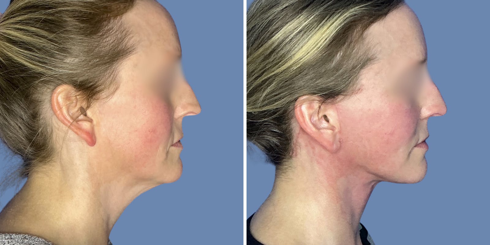 Facelift Before & After Gallery - Patient 197553 - Image 3
