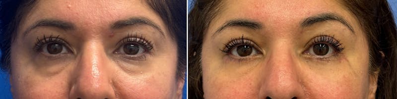 Patient WM5LaZ01SFKeYS451zjldg - Blepharoplasty Before & After Photos
