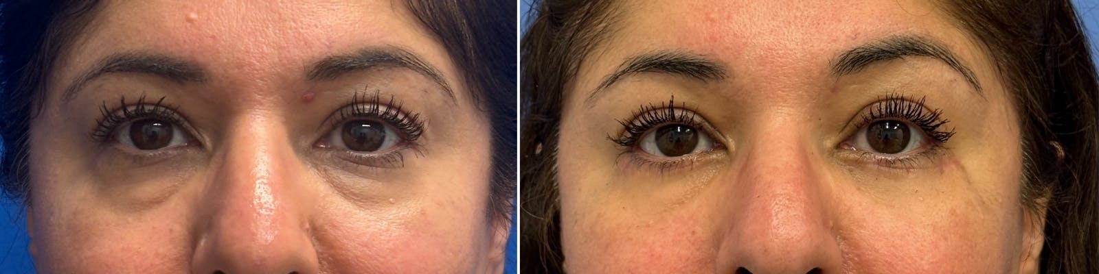 Blepharoplasty Before & After Gallery - Patient 315182 - Image 1