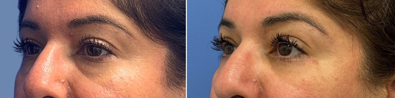 Blepharoplasty Before & After Gallery - Patient 315182 - Image 2