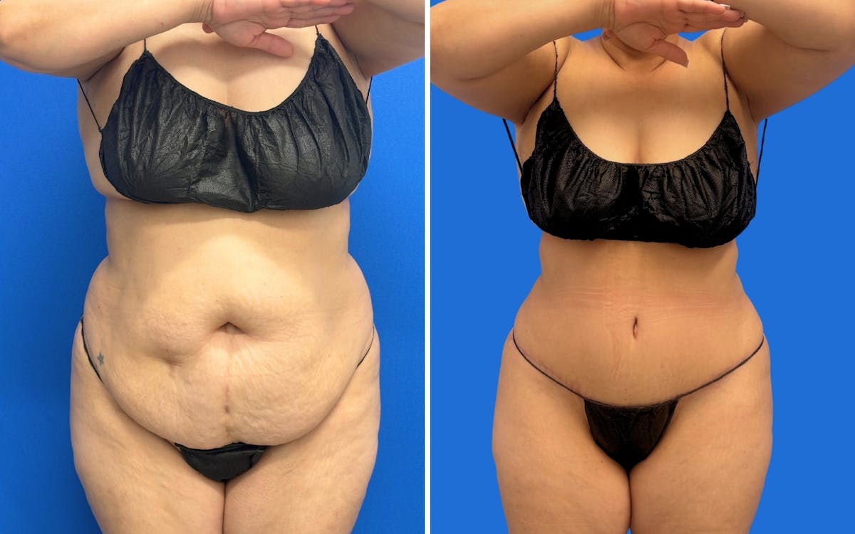 Abdominoplasty Before & After Gallery - Patient 249906 - Image 1