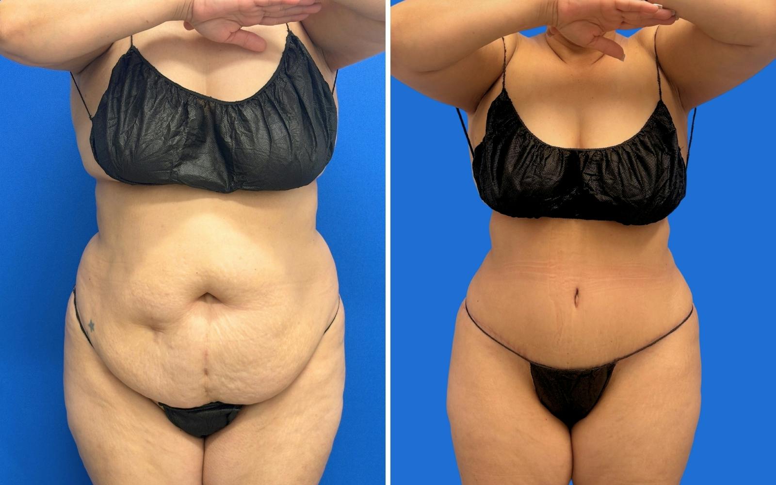 Abdominoplasty Before & After Gallery - Patient 249906 - Image 1