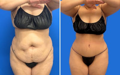 Abdominoplasty Before & After Gallery - Patient 249906 - Image 1