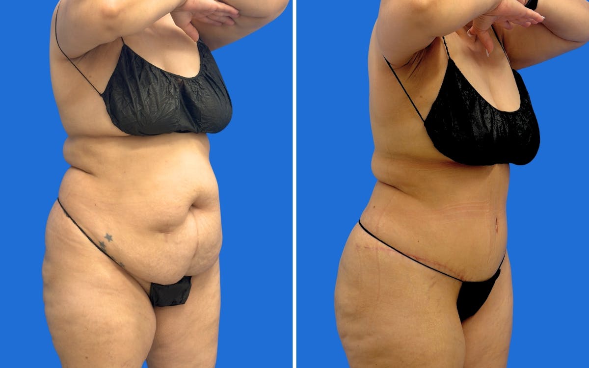Abdominoplasty Before & After Gallery - Patient 249906 - Image 2