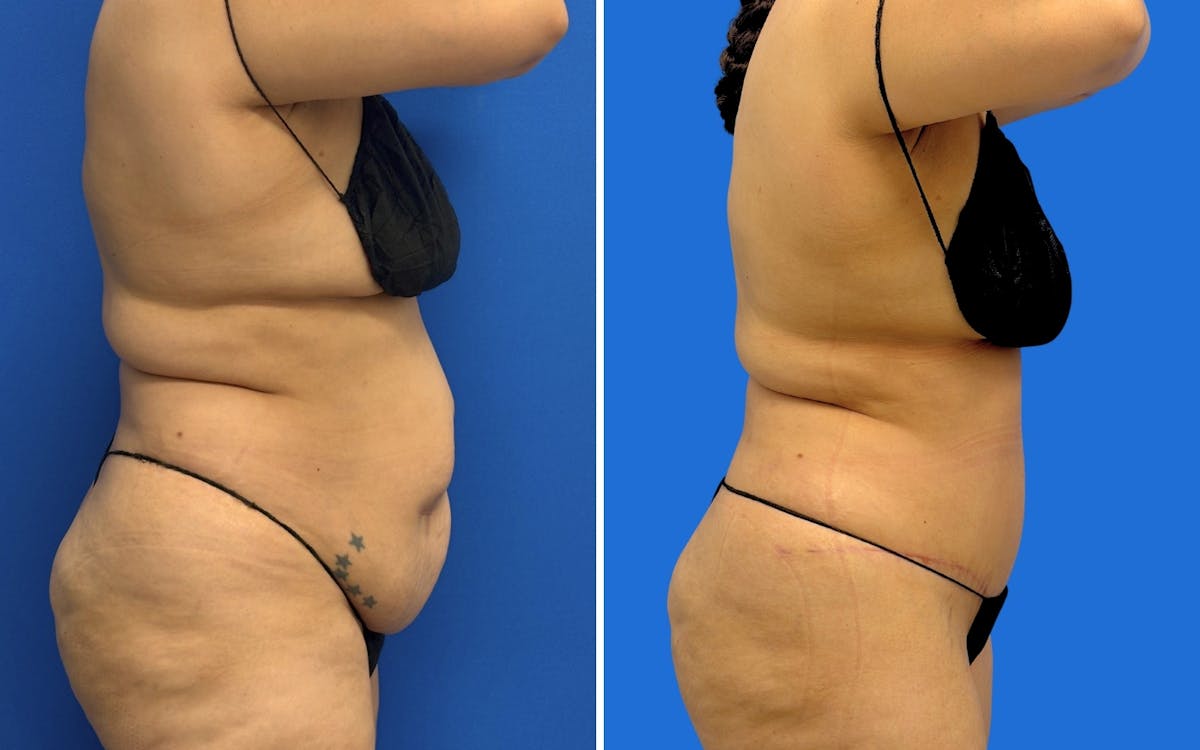Abdominoplasty Before & After Gallery - Patient 249906 - Image 3