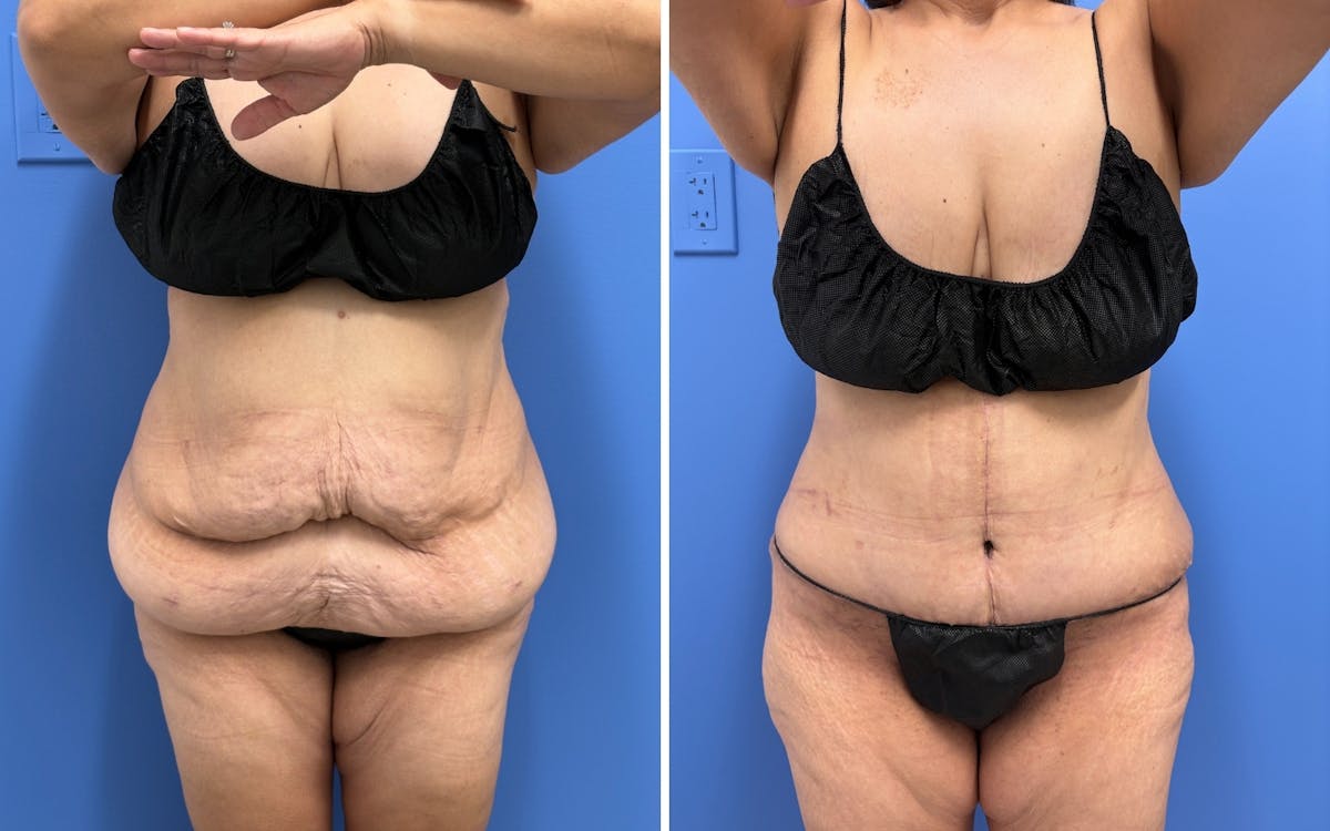 Abdominoplasty Before & After Gallery - Patient 347064 - Image 1