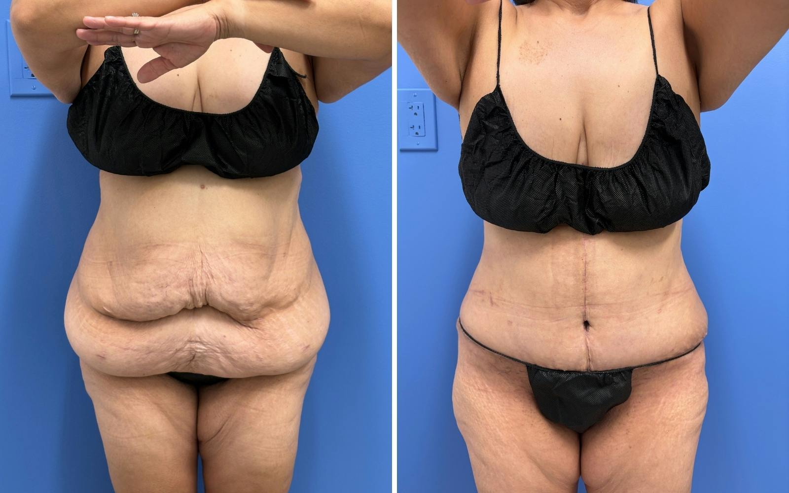 Abdominoplasty Before & After Gallery - Patient 347064 - Image 1