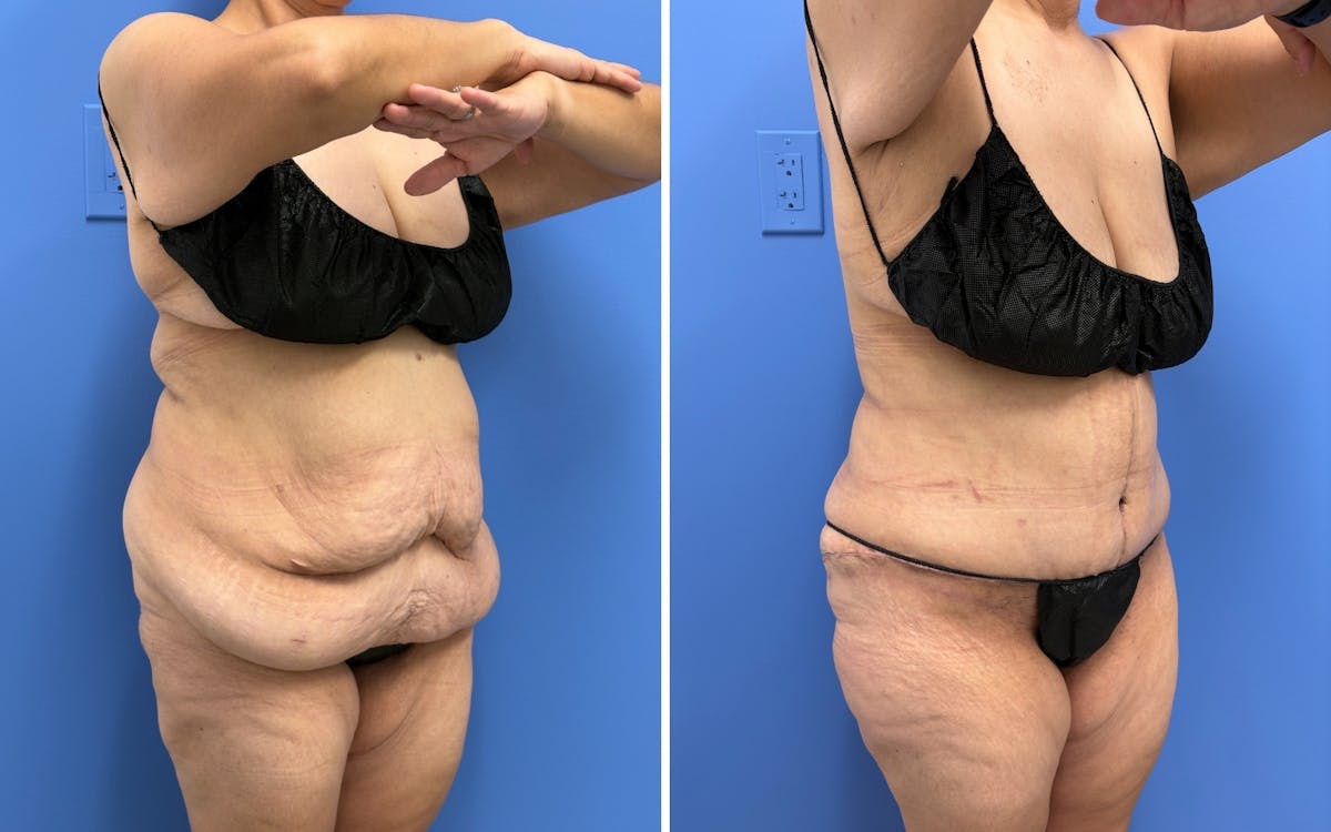 Abdominoplasty Before & After Gallery - Patient 347064 - Image 2