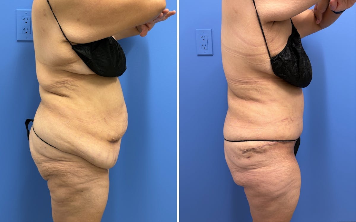 Abdominoplasty Before & After Gallery - Patient 347064 - Image 3