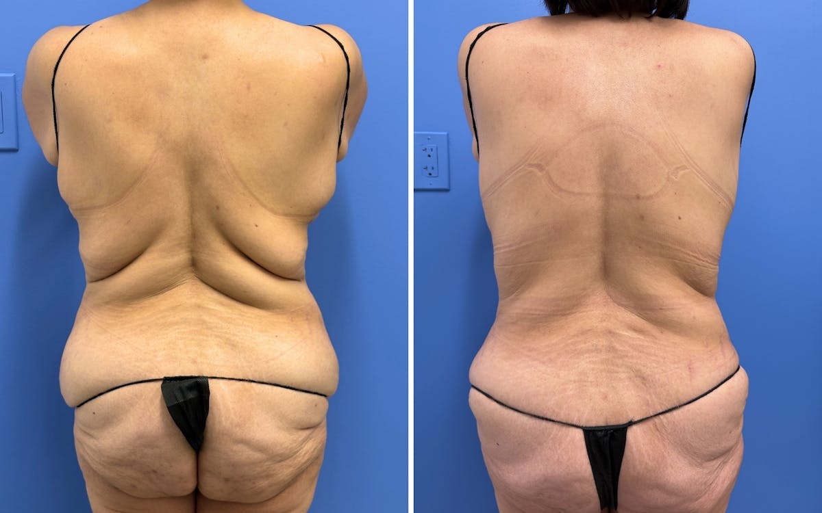 Abdominoplasty Before & After Gallery - Patient 347064 - Image 4