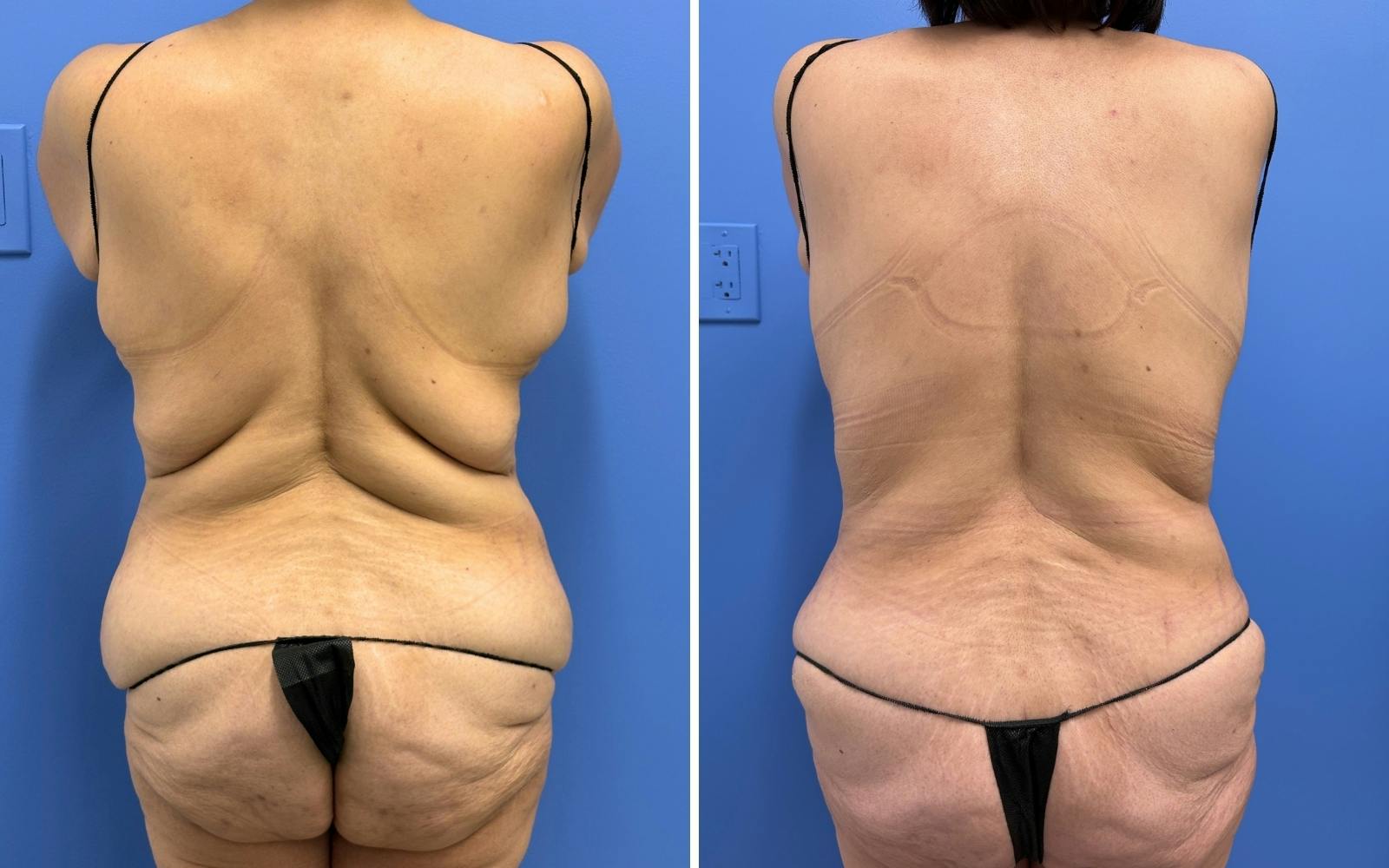 Abdominoplasty Before & After Gallery - Patient 347064 - Image 4
