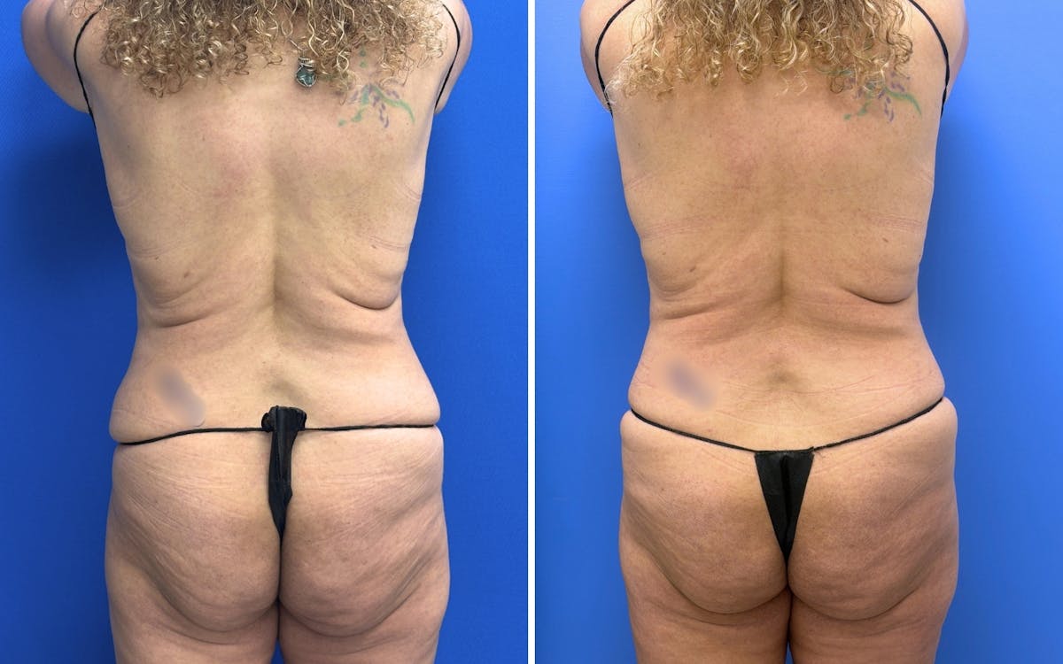 Abdominoplasty Before & After Gallery - Patient 119557 - Image 4
