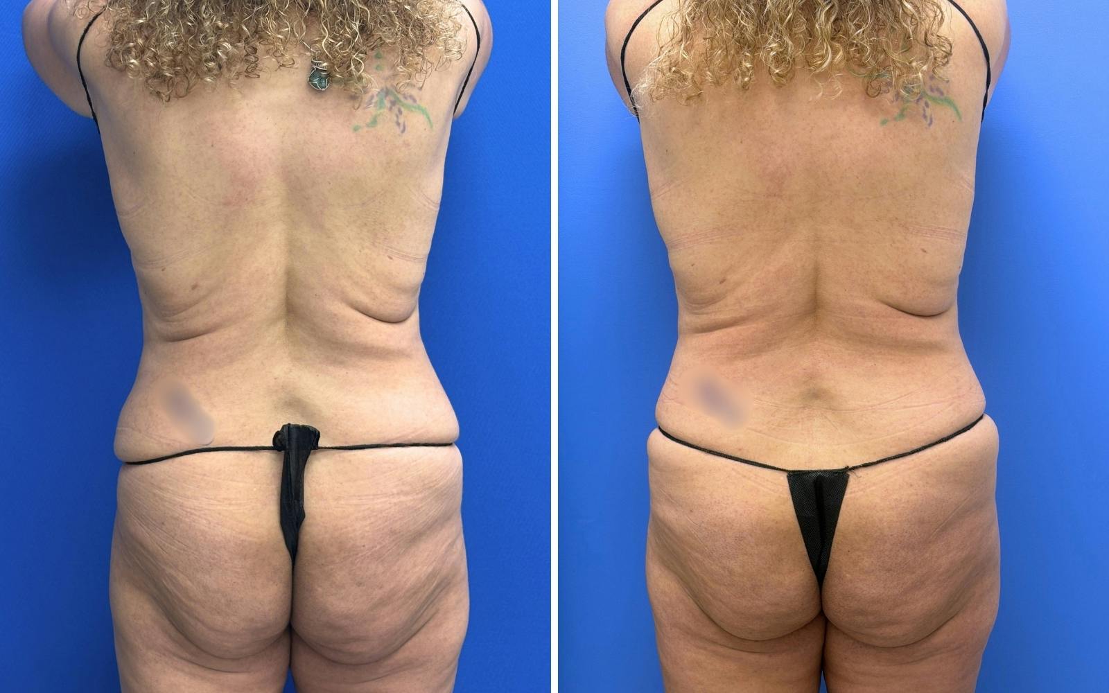 Abdominoplasty Before & After Gallery - Patient 119557 - Image 4