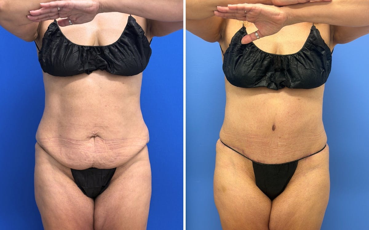 Abdominoplasty Before & After Gallery - Patient 119557 - Image 1
