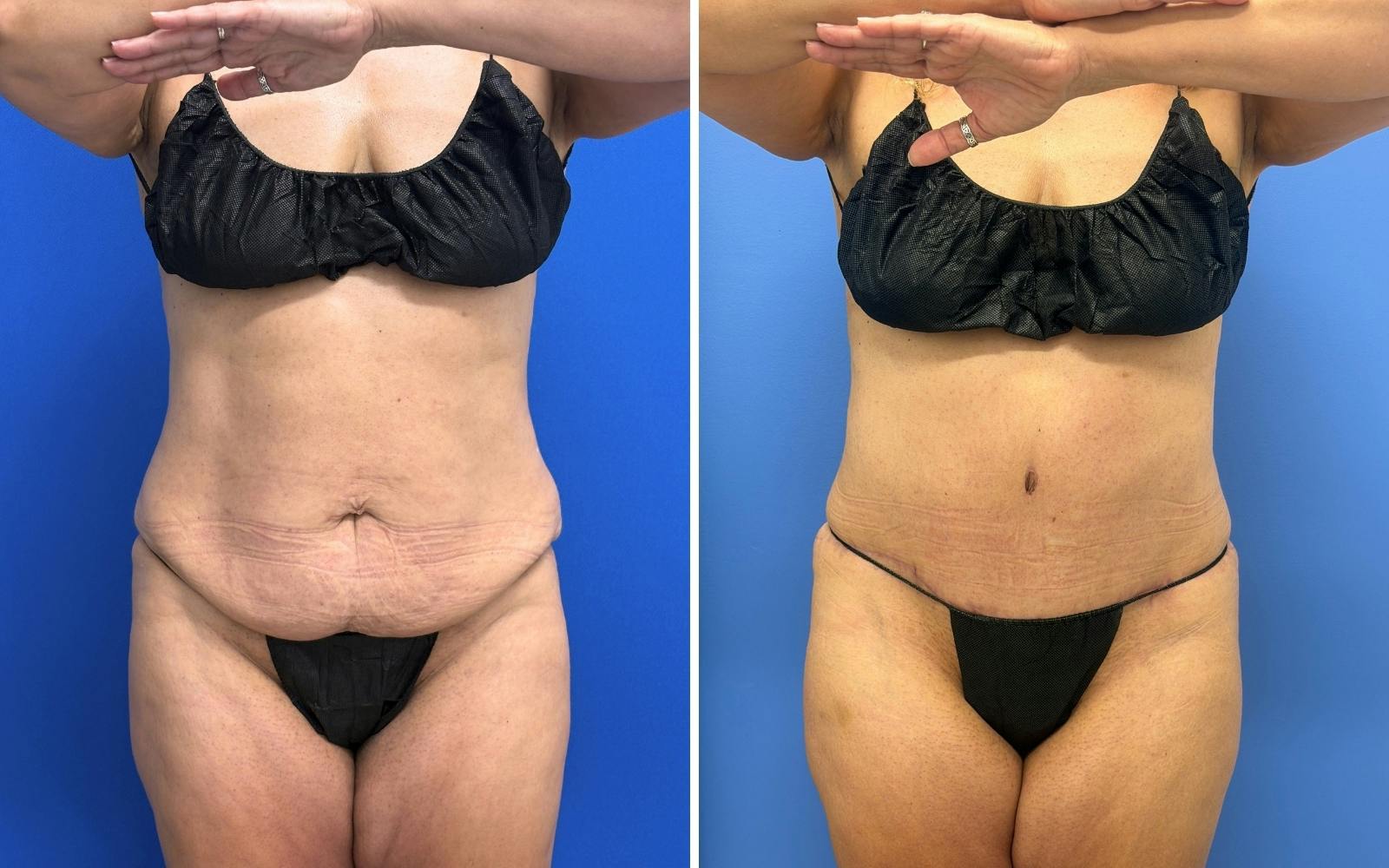 Abdominoplasty Before & After Gallery - Patient 119557 - Image 1