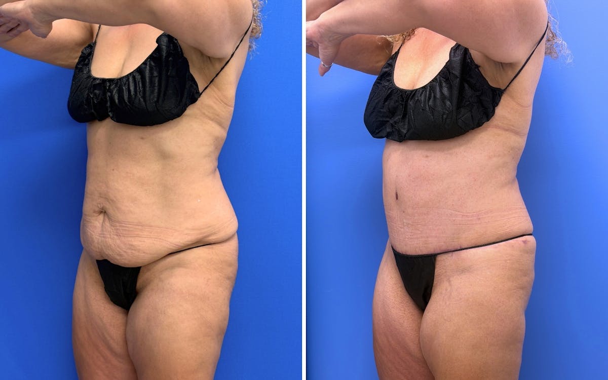 Abdominoplasty Before & After Gallery - Patient 119557 - Image 2