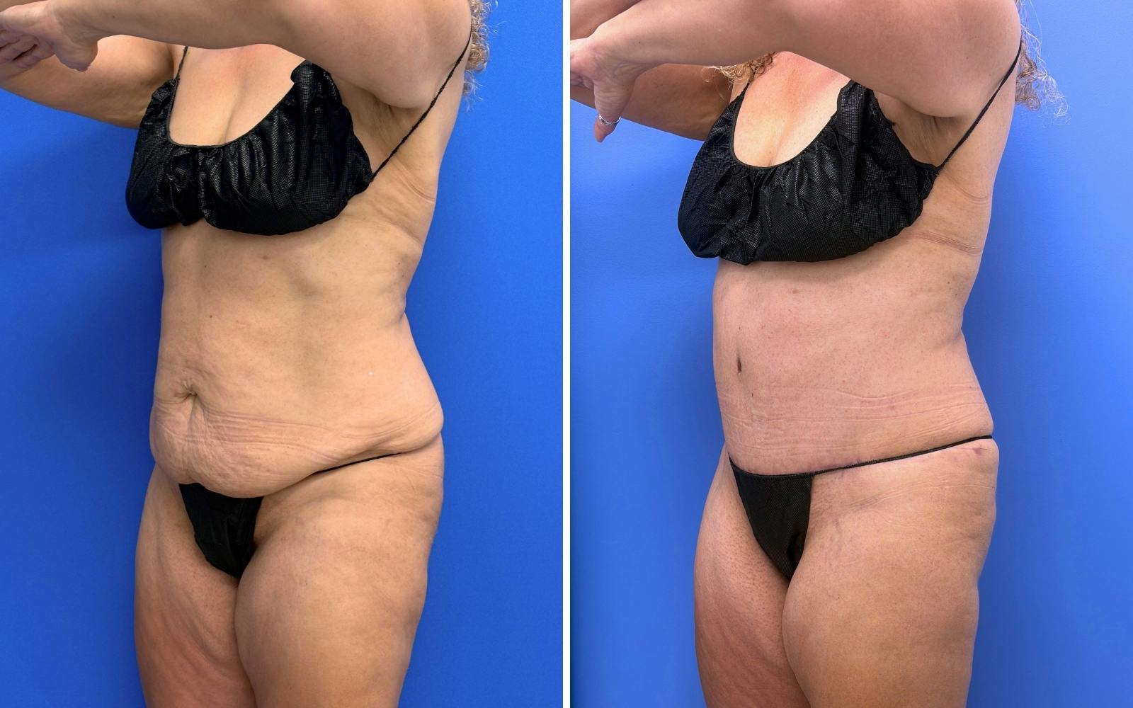 Abdominoplasty Before & After Gallery - Patient 119557 - Image 2