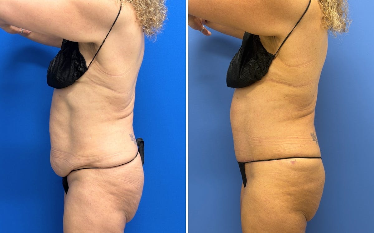 Abdominoplasty Before & After Gallery - Patient 119557 - Image 3