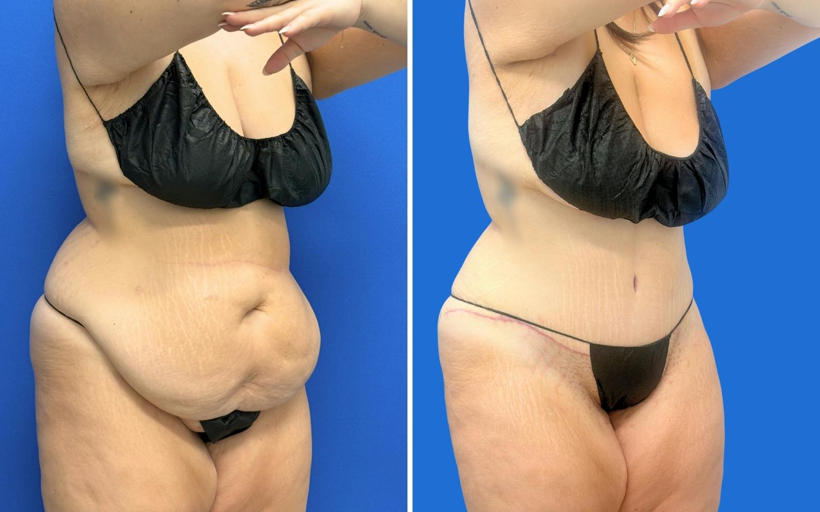Abdominoplasty Before & After Gallery - Patient 421499 - Image 1