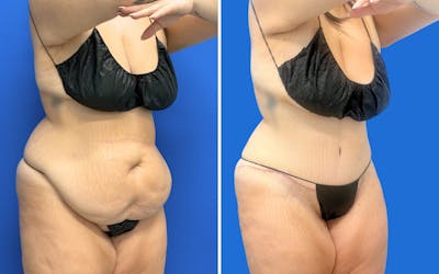 Abdominoplasty Before & After Gallery - Patient 421499 - Image 1