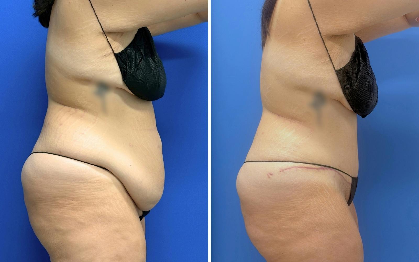 Abdominoplasty Before & After Gallery - Patient 421499 - Image 2