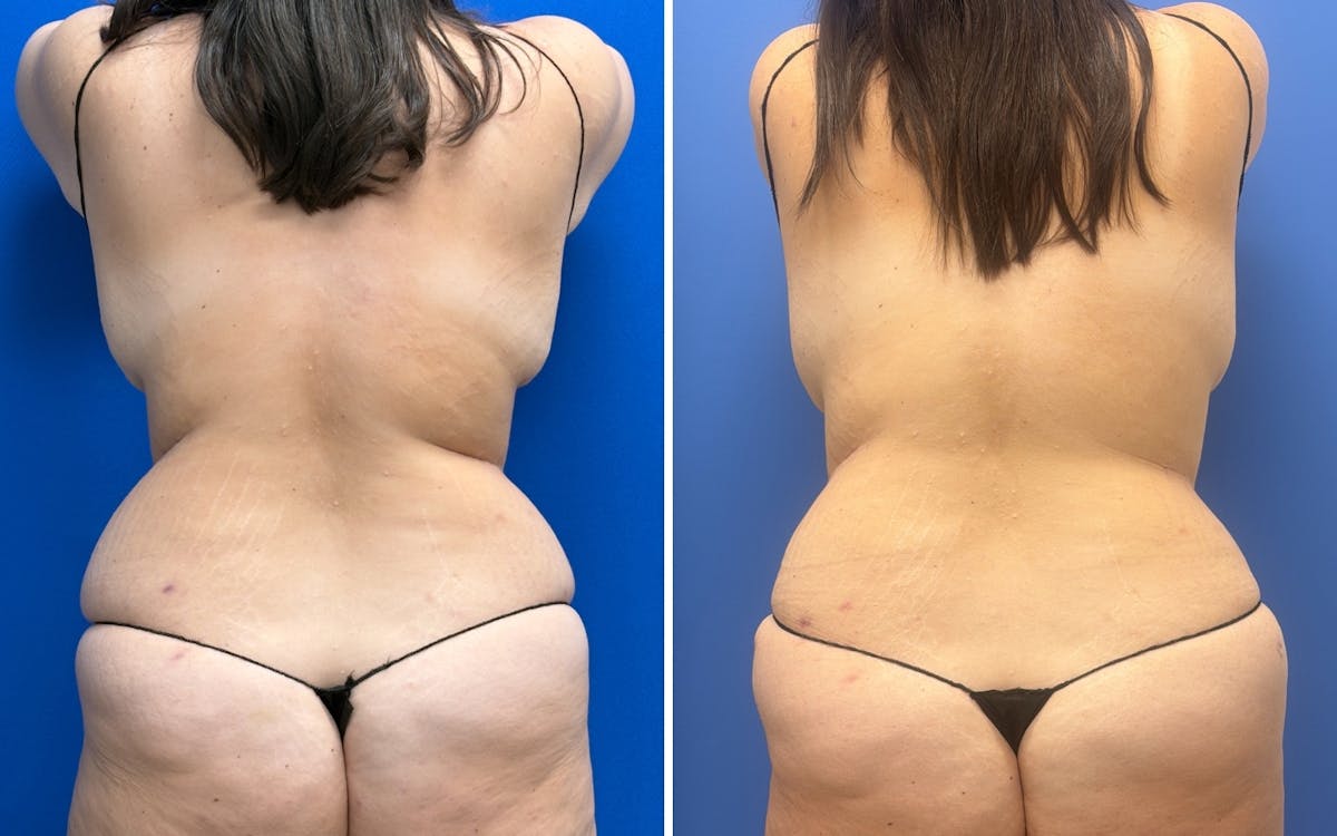 Abdominoplasty Before & After Gallery - Patient 421499 - Image 3