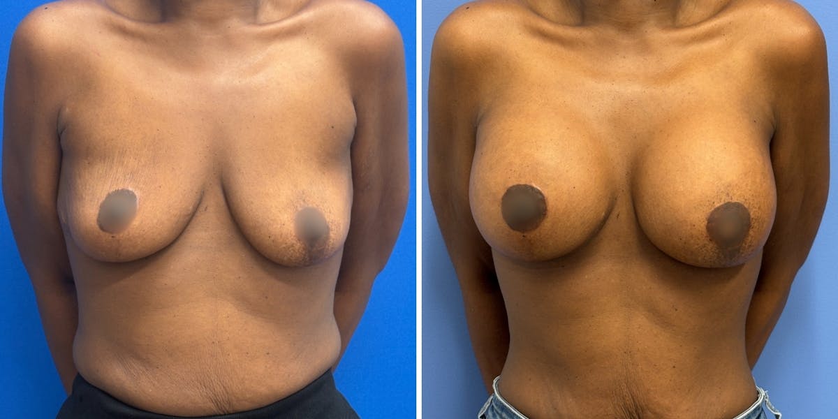 Breast Augmentation Before & After Gallery - Patient 178807 - Image 1