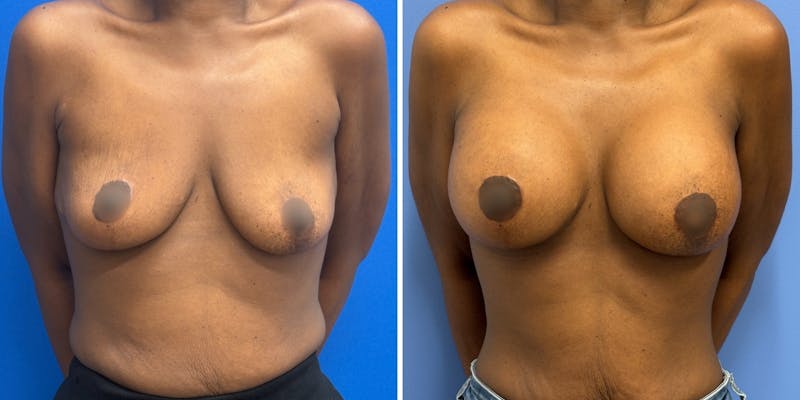 Patient HaNqEtcERPypBkta4ZsASg - Breast Augmentation Before & After Photos