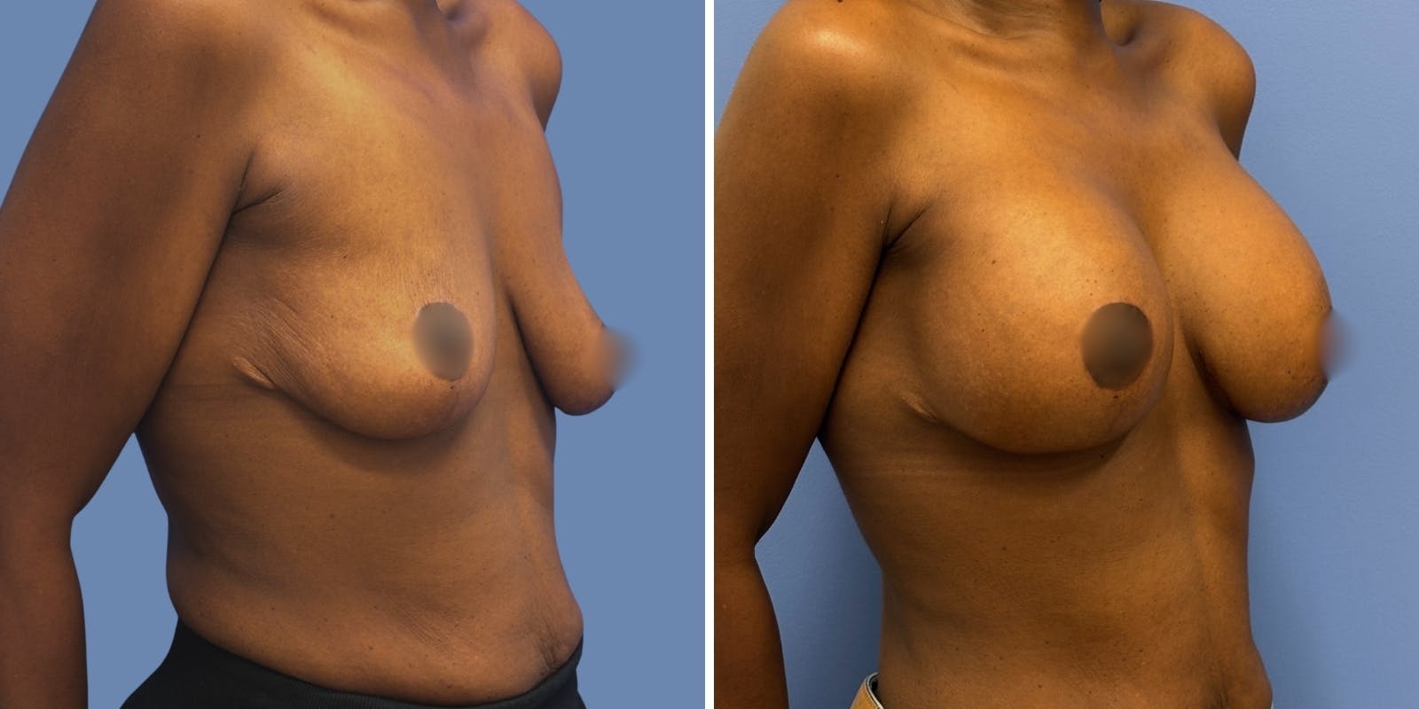 Breast Augmentation Before & After Gallery - Patient 178807 - Image 2