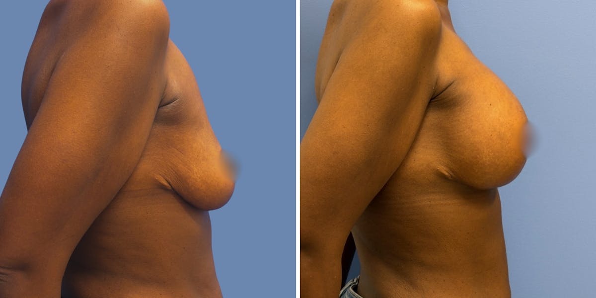 Breast Augmentation Before & After Gallery - Patient 178807 - Image 3