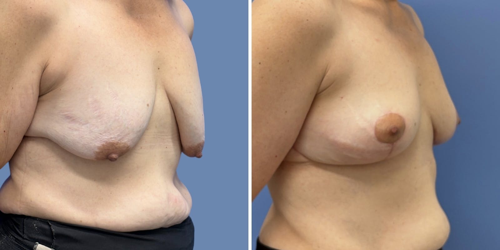 Breast Augmentation Before & After Gallery - Patient 378058 - Image 2