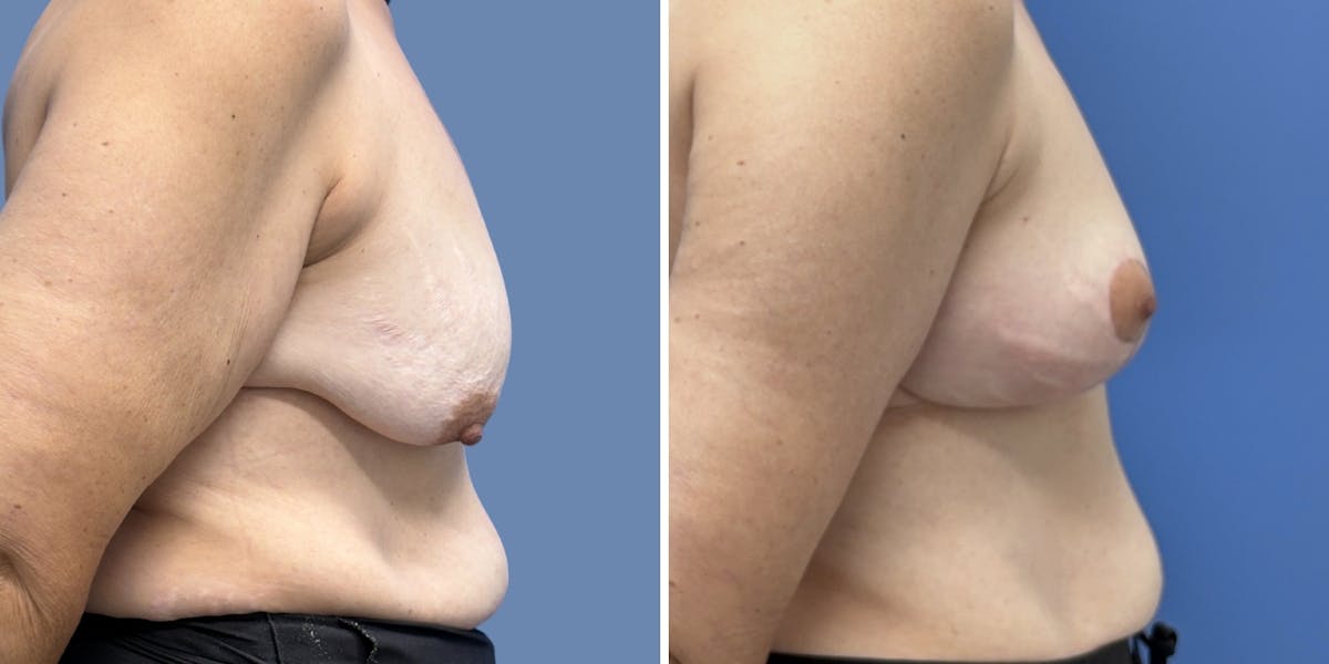 Breast Augmentation Before & After Gallery - Patient 378058 - Image 3