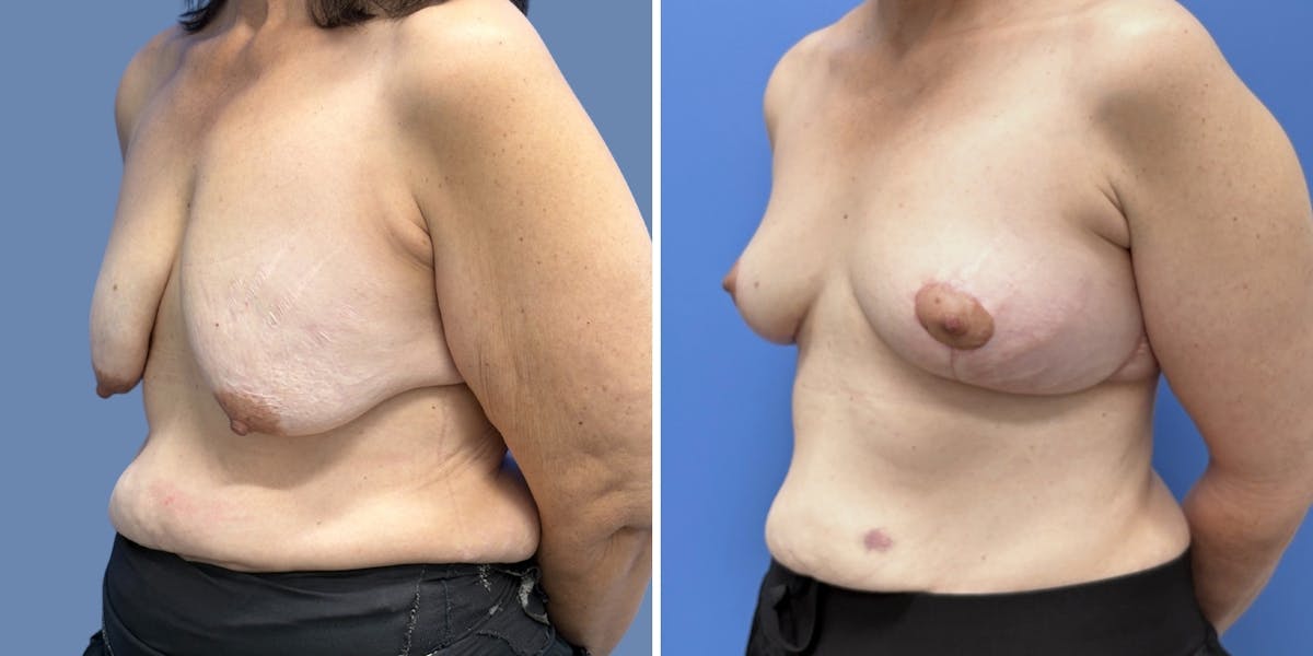 Breast Augmentation Before & After Gallery - Patient 378058 - Image 4