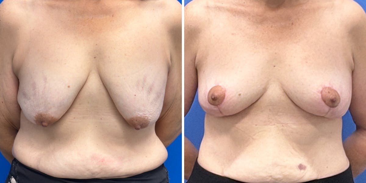 Breast Augmentation Before & After Gallery - Patient 378058 - Image 1