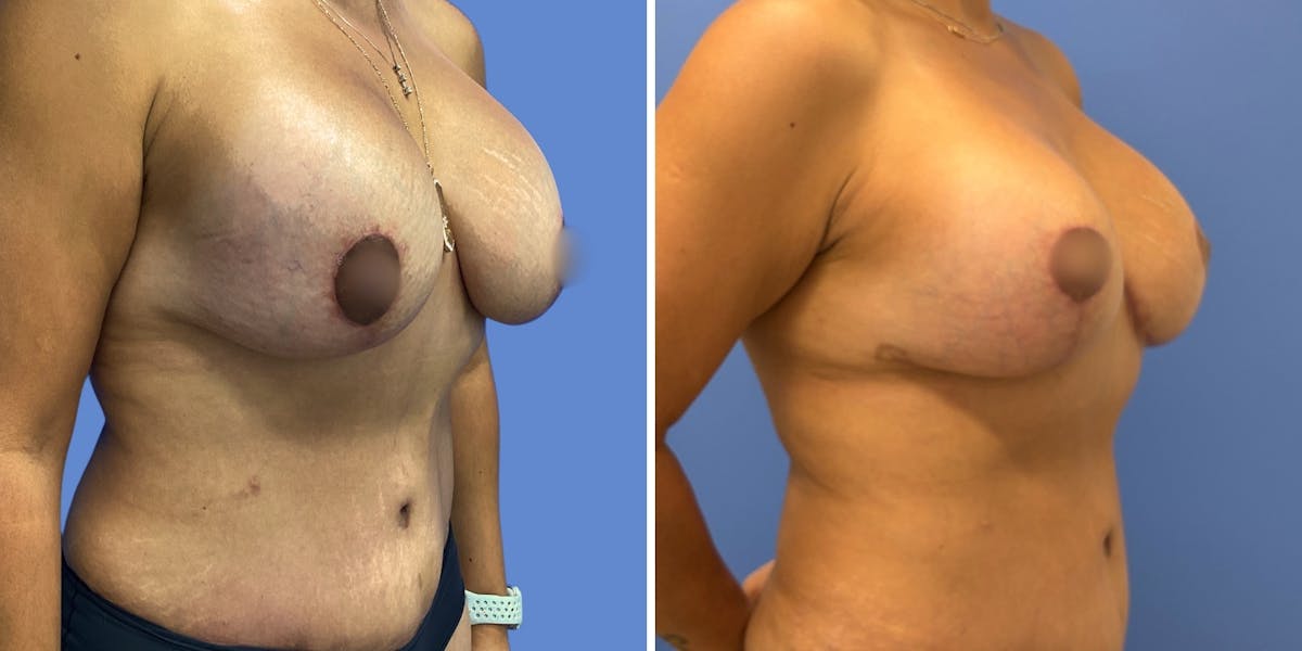 Breast Revision Before & After Gallery - Patient 183202 - Image 2