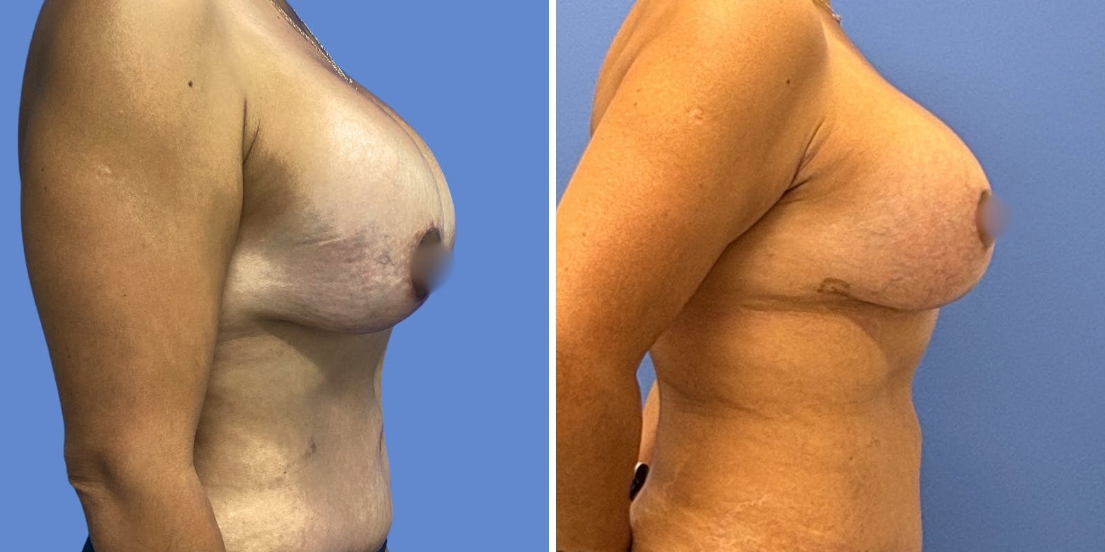 Breast Revision Before & After Gallery - Patient 183202 - Image 3