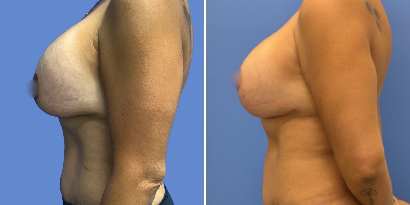 Breast Revision Before & After Gallery - Patient 183202 - Image 4