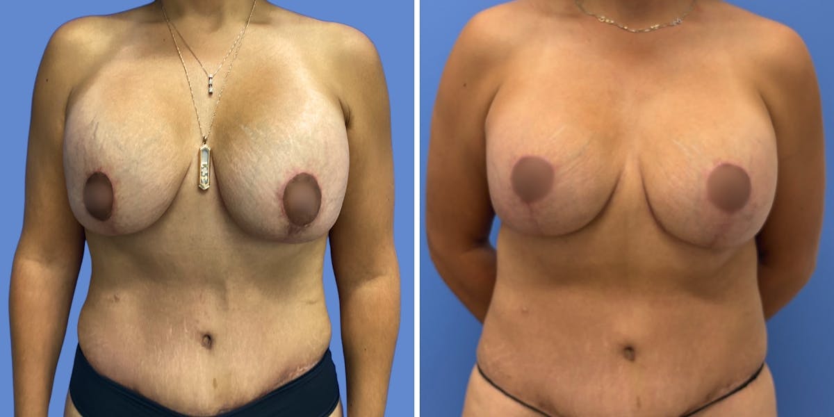Breast Revision Before & After Gallery - Patient 183202 - Image 1