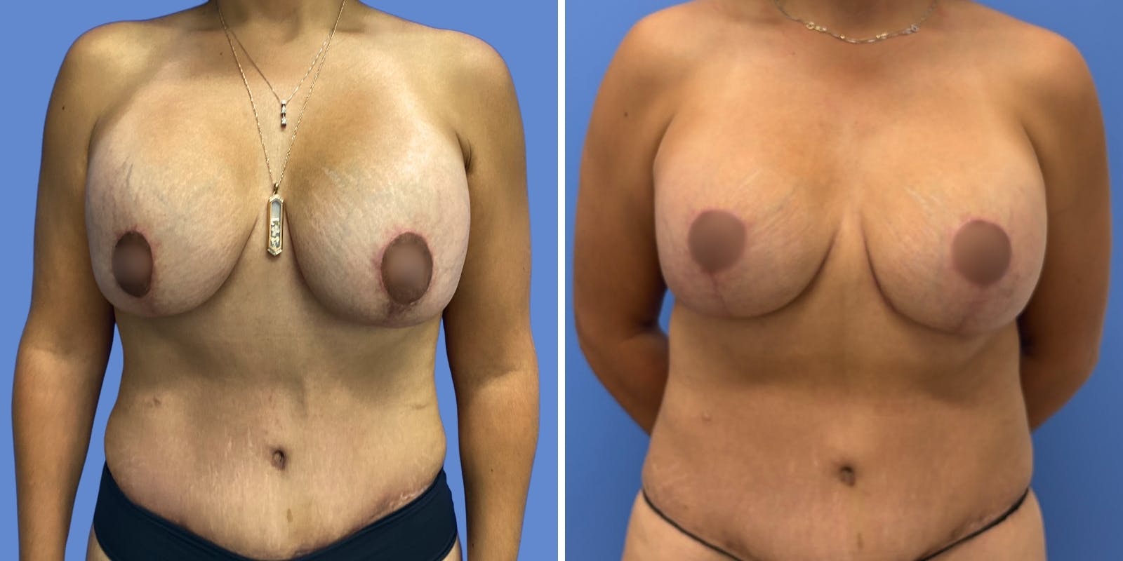 Breast Revision Before & After Gallery - Patient 183202 - Image 1