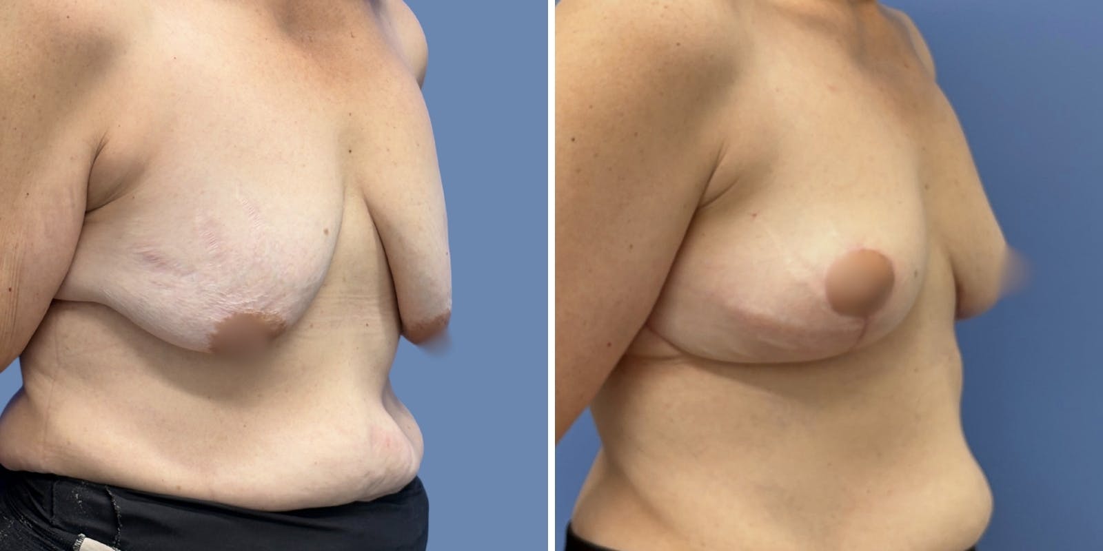 Breast Lift Before & After Gallery - Patient 160020 - Image 2
