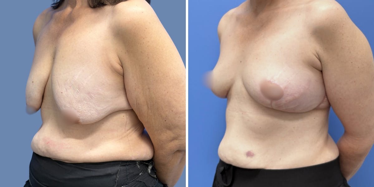 Breast Lift Before & After Gallery - Patient 160020 - Image 4