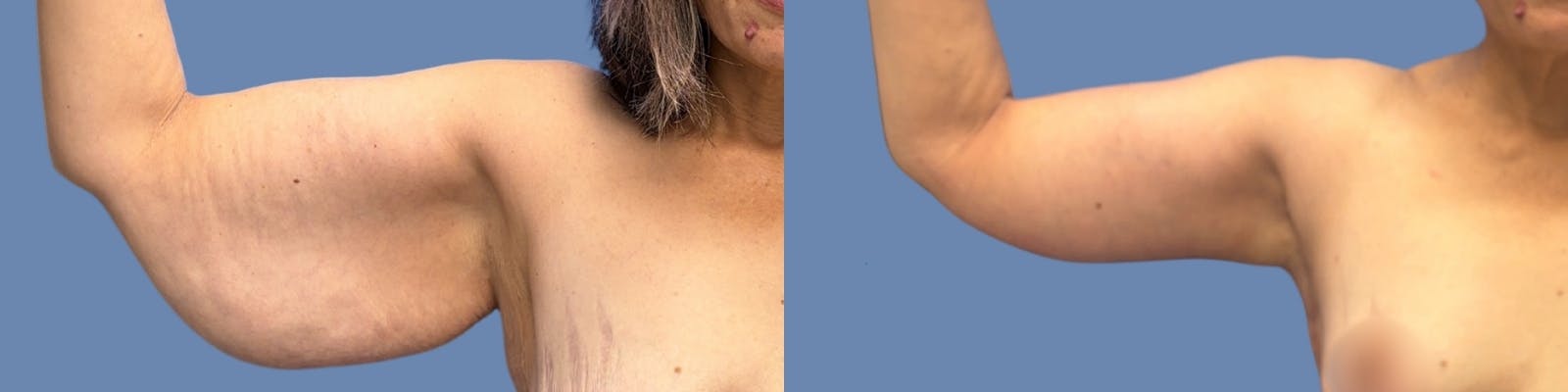 Brachioplasty Before & After Gallery - Patient 146950 - Image 2