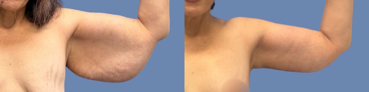 Brachioplasty Before & After Gallery - Patient 146950 - Image 1