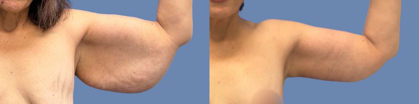 Brachioplasty Before & After Gallery - Patient 146950 - Image 1