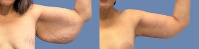 Brachioplasty Before & After Gallery - Patient 146950 - Image 1