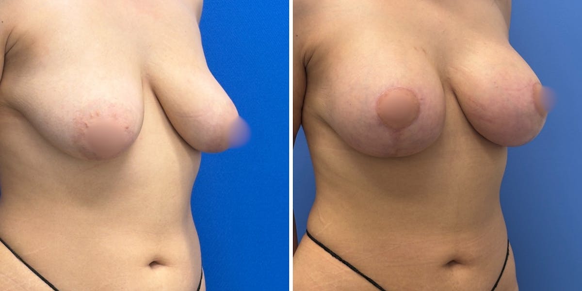 Breast Augmentation & Lift Before & After Gallery - Patient 636795 - Image 3